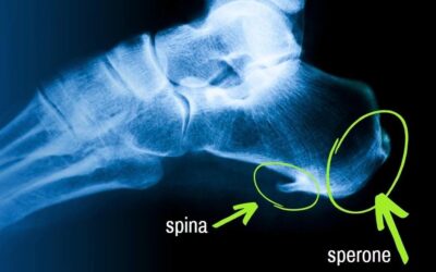 Spina calcaneare: capire la causa per trattarla davvero